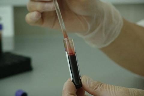 Se registra el primer caso de un hombre con VIH resistente a fármacos antirretrovirales
