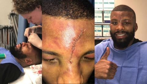 Oponente de Pacquiao sufre corte en la cara previa a su pelea